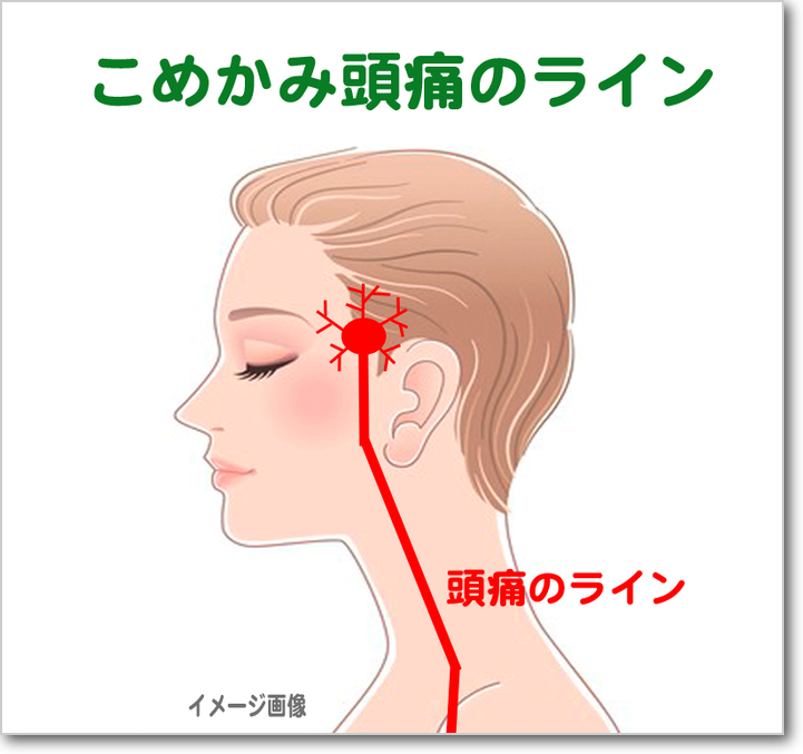 頭痛 こめかみ の 上 ブログ ニュース 頭痛 こめかみ の 上 ブログ ニュース