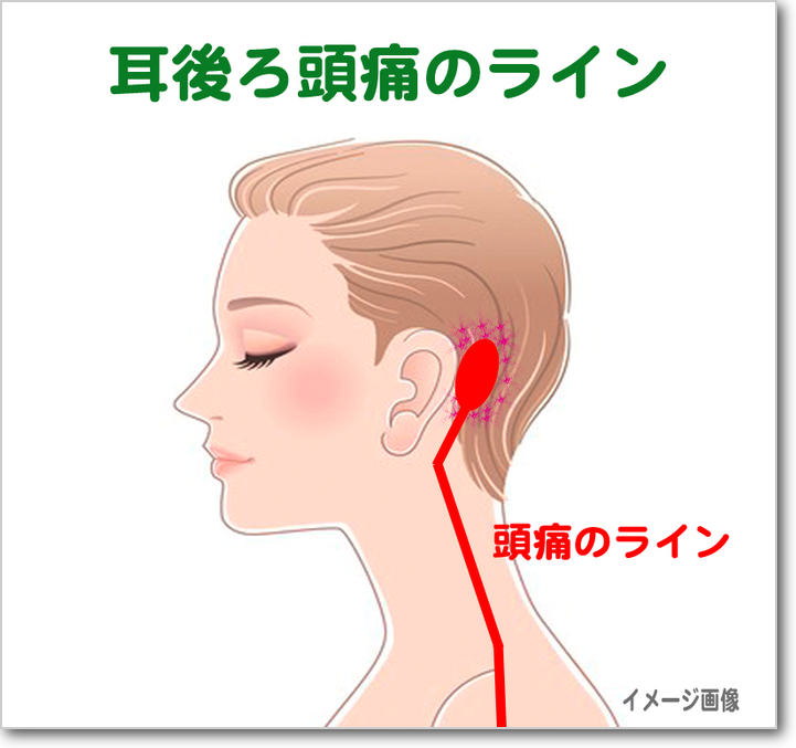耳うしろの頭痛が改善 38歳女性 京都市 頭痛こり改善日記 頭痛専門整体院 平安コンディショニング 片頭痛 子供頭痛 群発頭痛専門 耳うしろの頭痛が改善 38歳女性 京都市 頭痛こり改善日記 頭痛専門整体院 平安コンディショニング 片頭痛 子供頭痛 群発頭痛専門